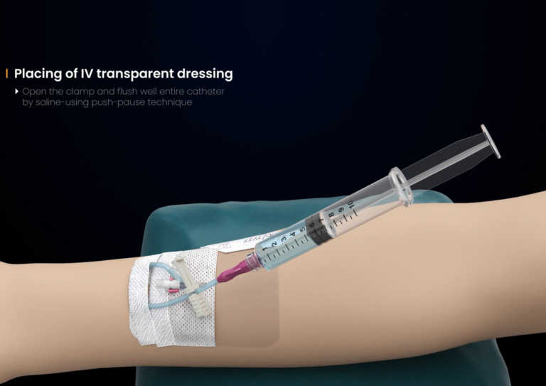 Wizualizacja 3D procedury medycznej IV dressing cewnik Sol-Millennium