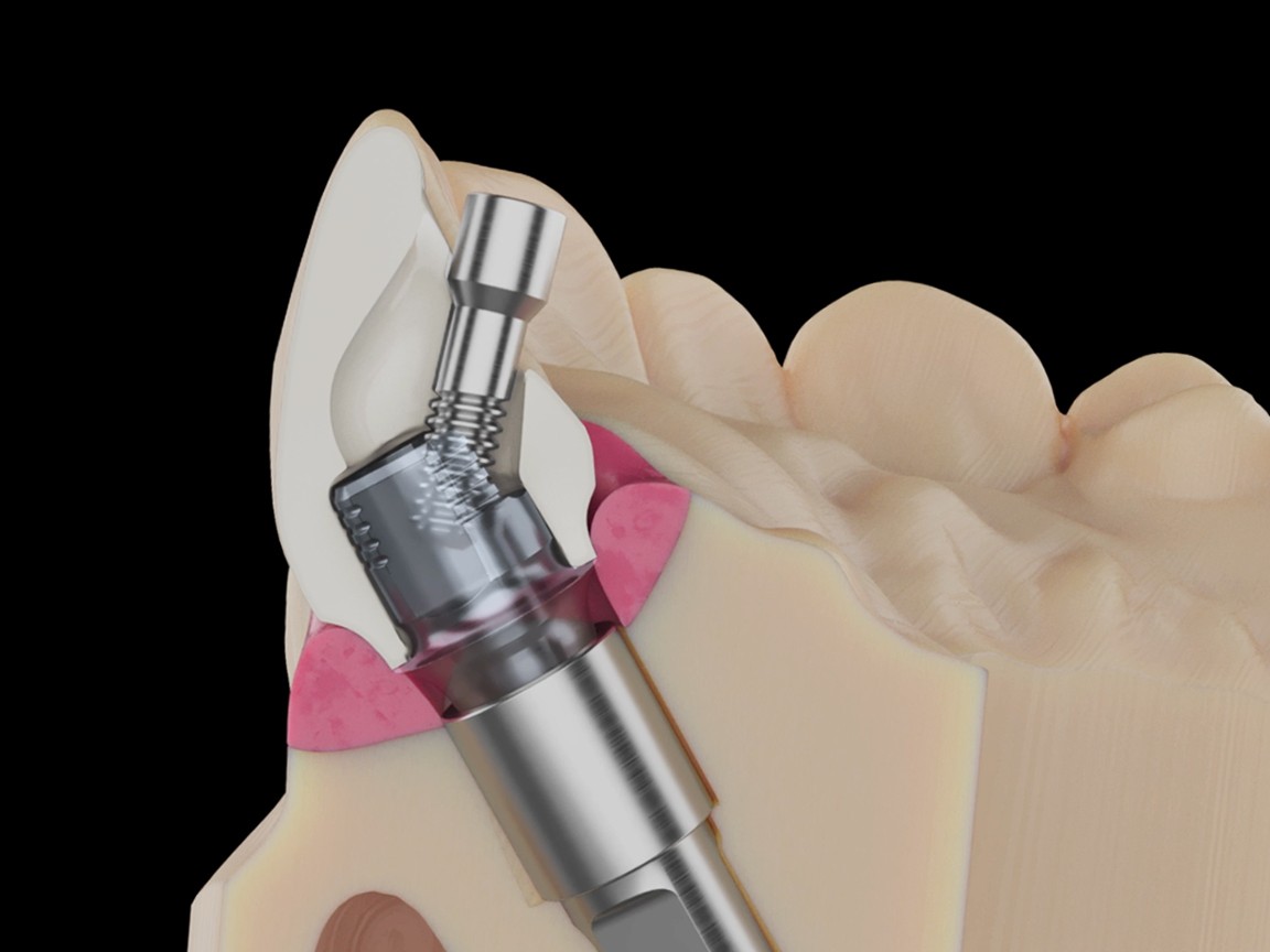 wizualizacja dentystyczna, grafika 3D przekroju szczęki przedstawiająca instalacje łącznika implantologicznego