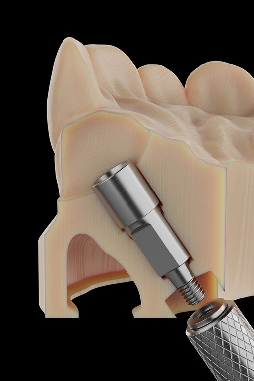 3d dental cross section with implant abutment instalation proces