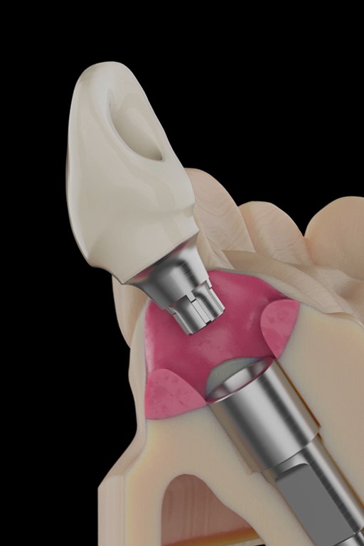 wizualizacja dentystyczna montażu implantu pokazana jako grafika 3d w przekroju