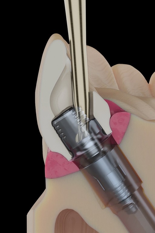 wizualizacja przekroju procesu instalacji łączników implantologicznych